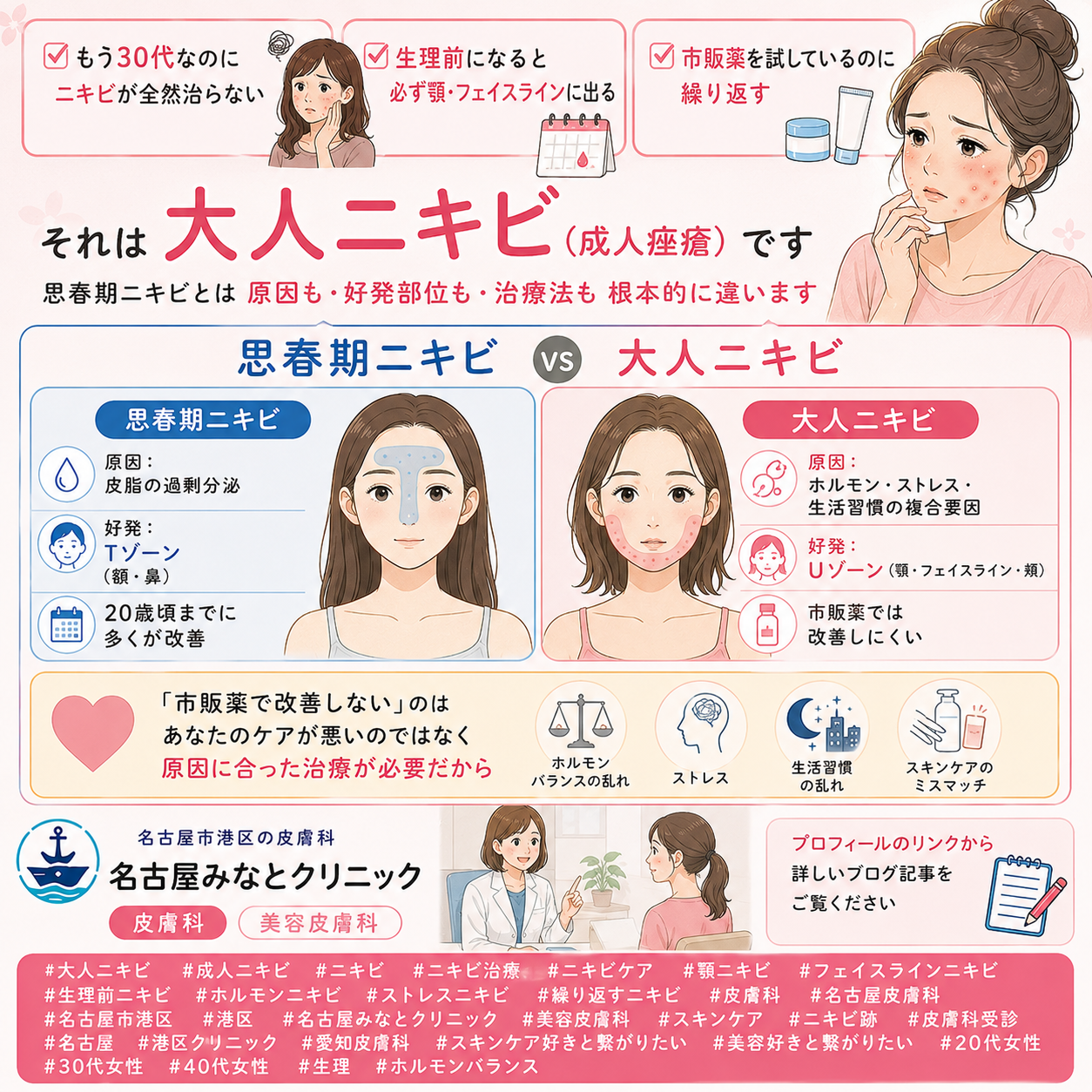 大人ニキビ（成人痤瘡）——思春期ニキビとの違い・ホルモン・ストレス・最新治療を名古屋みなとクリニック（名古屋市港区・皮膚科）が詳しく解説