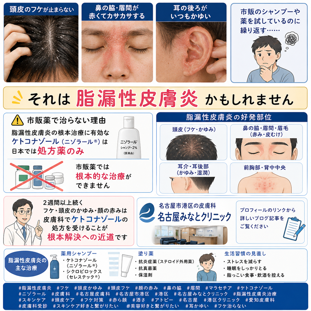 脂漏性皮膚炎——頭皮のフケ・顔の赤み・かゆみの原因と正しい治療を名古屋みなとクリニック（名古屋市港区・皮膚科）が詳しく解説